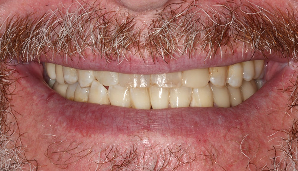 closeup of patient of Dr. Hill before treatment