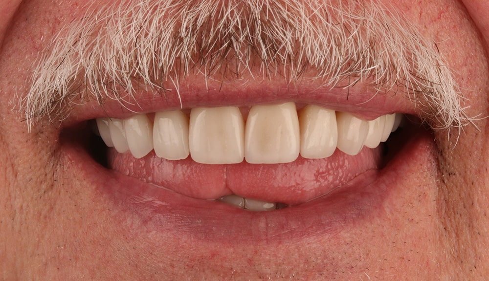 closeup of patient of Dr. Hill, St. Louis dentist after treatment
