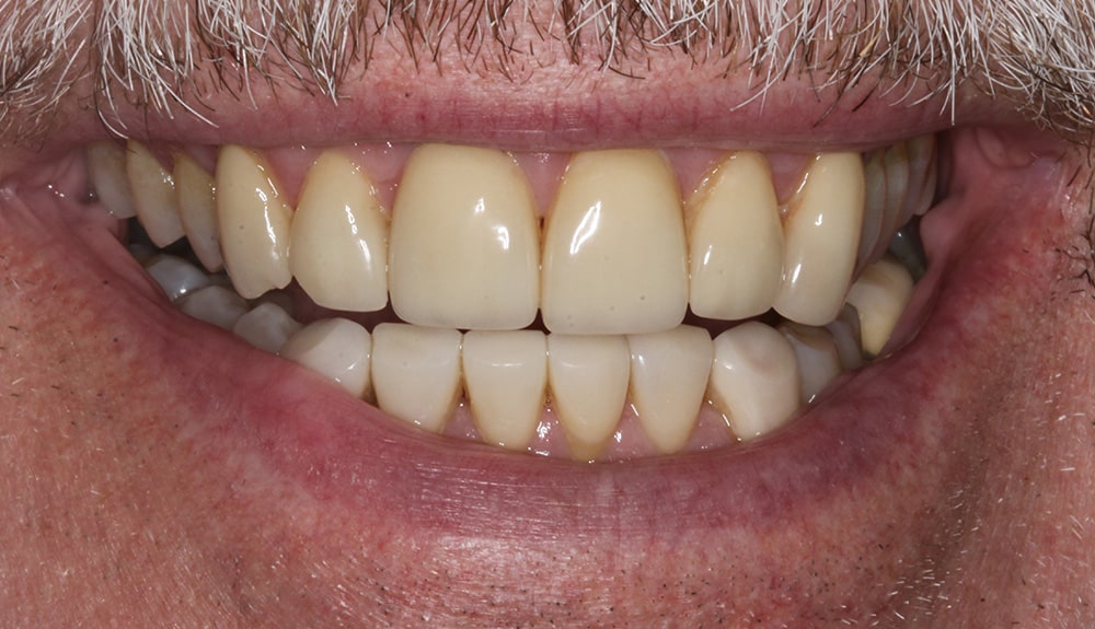 closeup of patient of Dr. Hill, St. Louis dentist before treatment