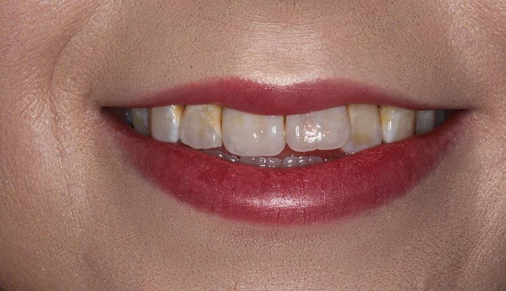 closeup of patient of Dr. Hill before treatment