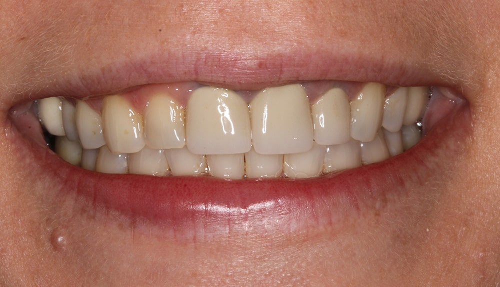 closeup of patient of Dr. Hill after treatment