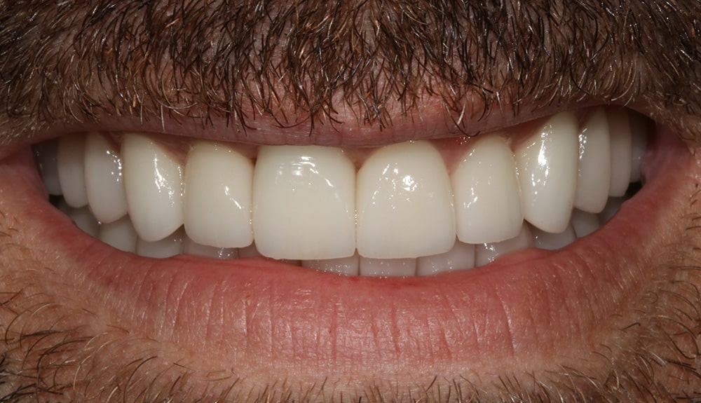 closeup of patient of Dr. Hill, St. Louis dentist after treatment