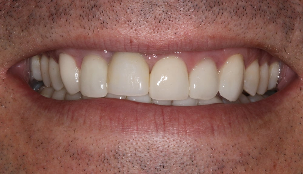 closeup of patient of Dr. Hill after treatment