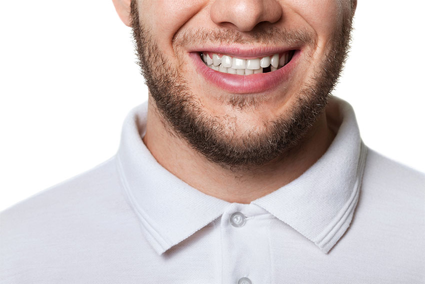 young man in polo shirt smiles, showing off a missing tooth