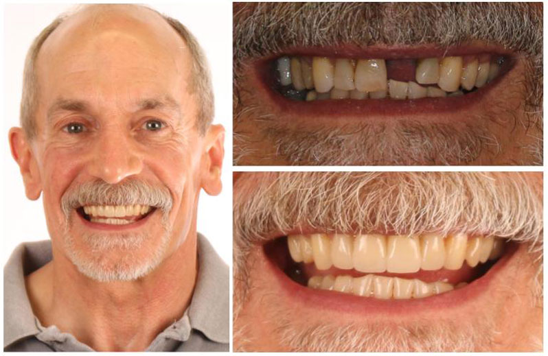 man smiling, showing the before and after effects of dental implants