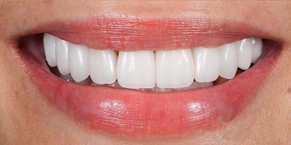 Patient Smile After Treatment for crooked smile
