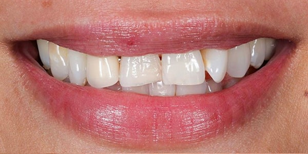 Patient Smile Before Treatment for crooked smile