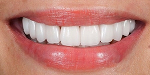 closeup of teeth After treatment for crooked smile