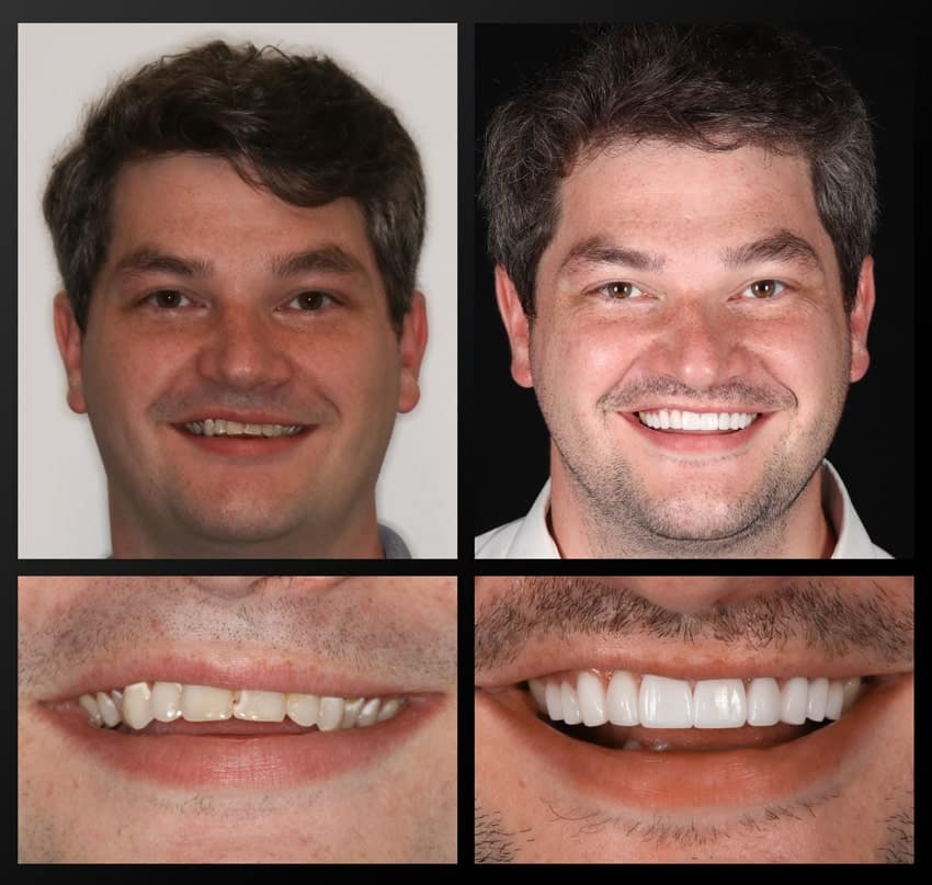 photo collage of patient's smile before and after treatment